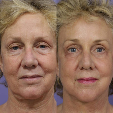 Vitae Charm Led Mask