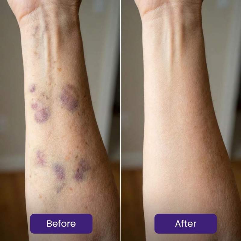 Vitae Charm Body Oil for Bruising Skin