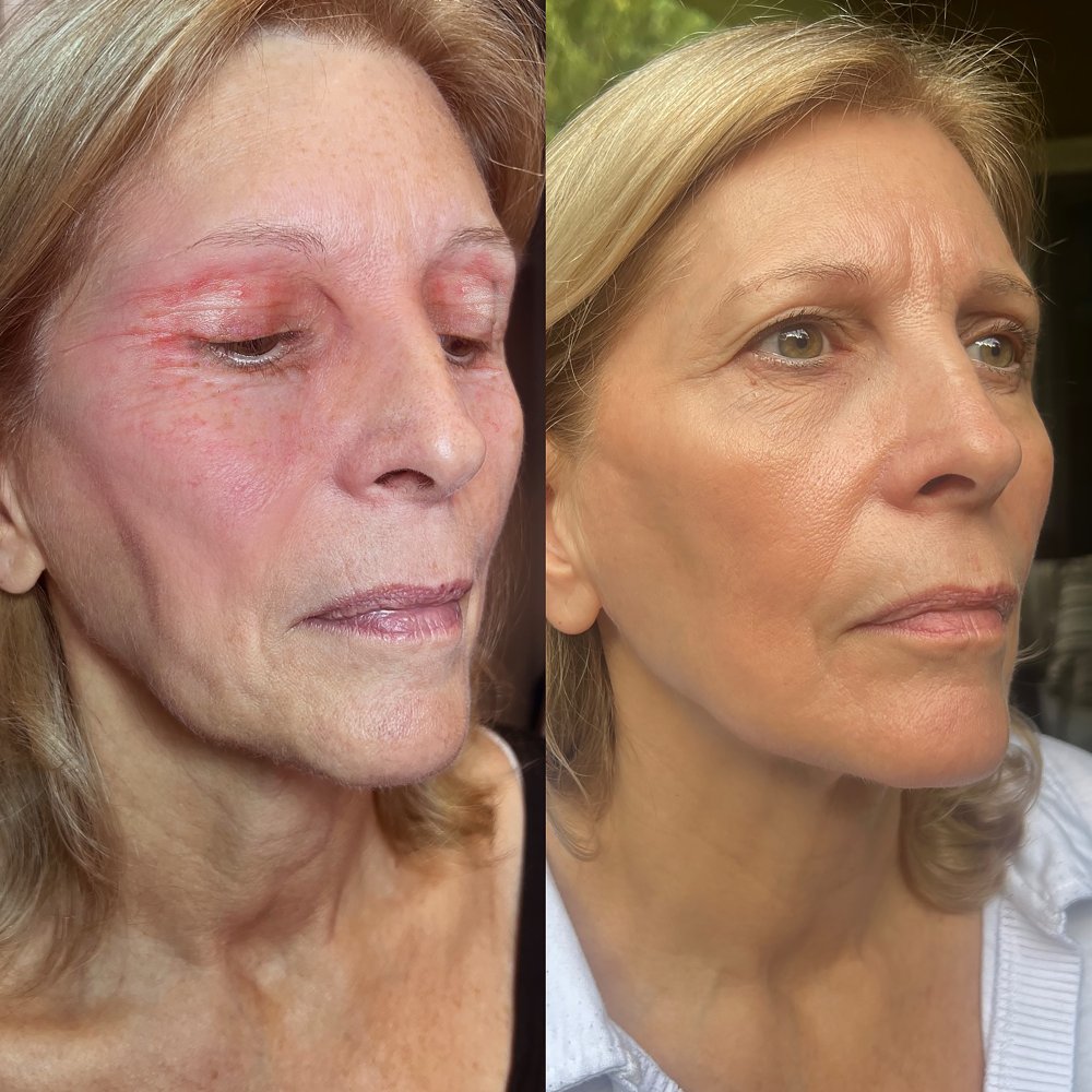 Vitae Charm ExoVita Essence - Eye Area Damage.