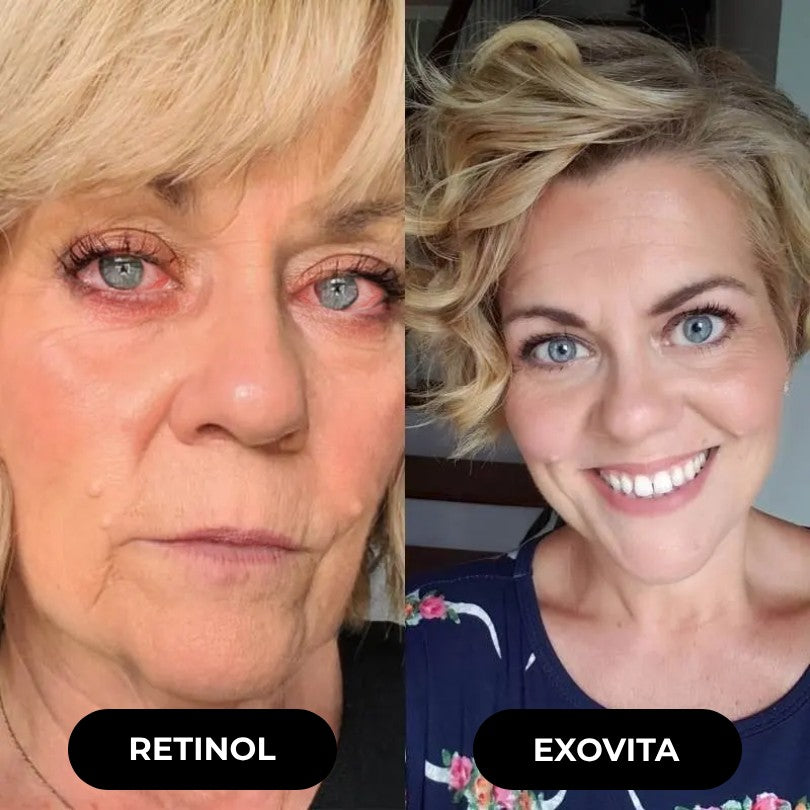 Vitae Charm ExoVita Essence - Eye Area Damage.